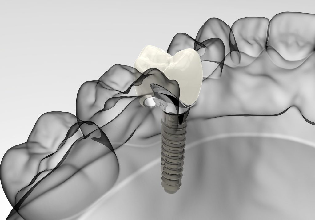 Odontólogo en Puente de Vallecas y Tetuán Madrid, dentista en Puente de Vallecas y Tetuán Madrid, clínica dental en Puente de Vallecas y Tetuán Madrid
