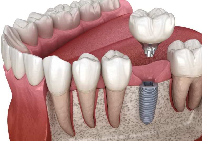 Odontólogo en Puente de Vallecas y Tetuán Madrid, dentista en Puente de Vallecas y Tetuán Madrid, clínica dental en Puente de Vallecas y Tetuán Madrid