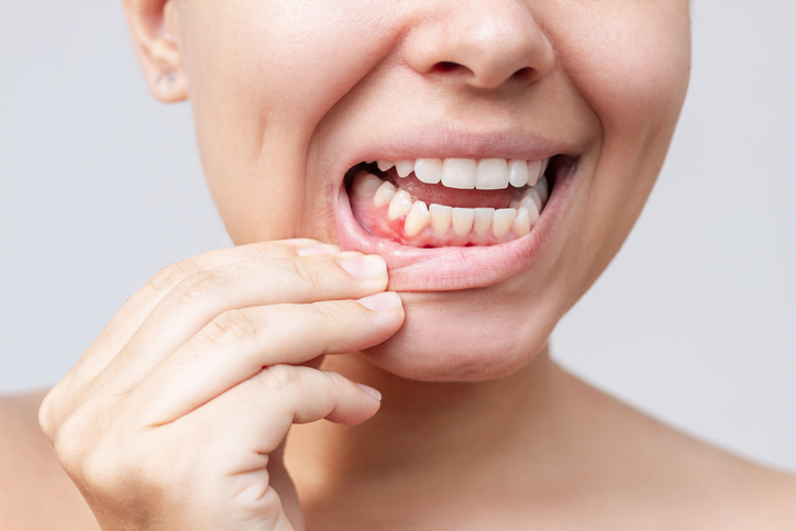 enfermedad periodontal y salud cardiovascular